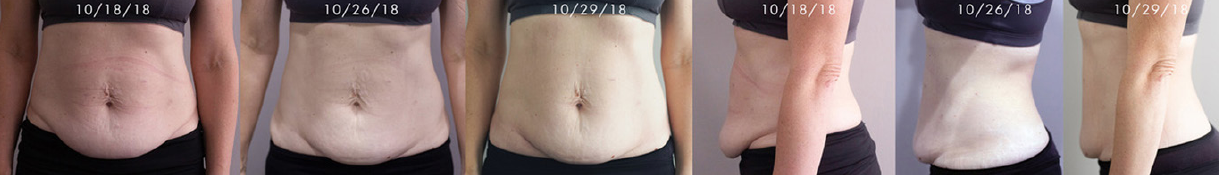LipoMelt targets fat while you take a nap